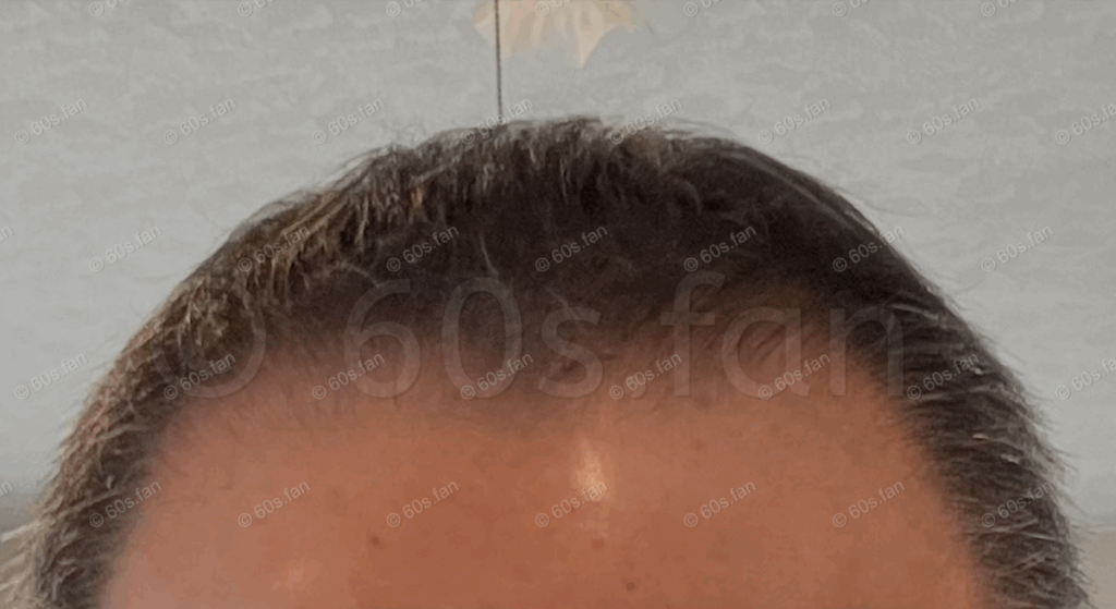 リアップ使用4ヶ月3週間後の前頭部（2025年11月22日）