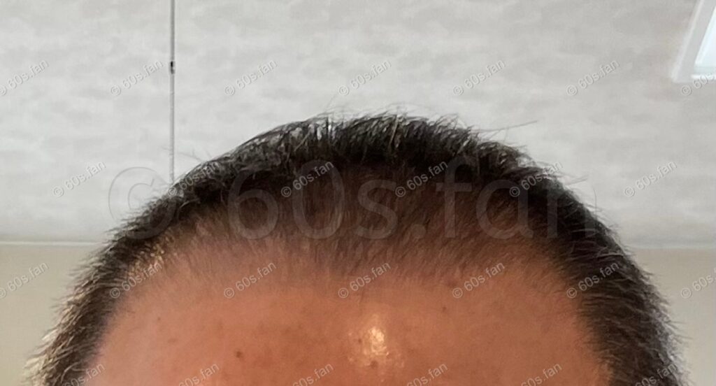 リアップ使用3ヶ月後の前頭部の発毛経過（2025年10月）