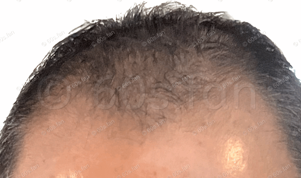 カークランド中止後の炎症による脱毛（2025年8月）