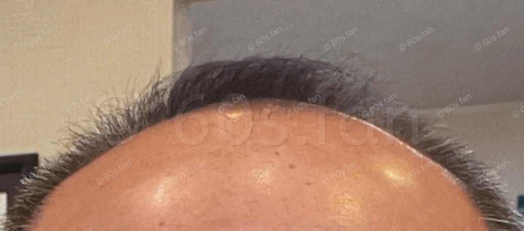 カークランド使用開始時の前頭部（2024年12月）