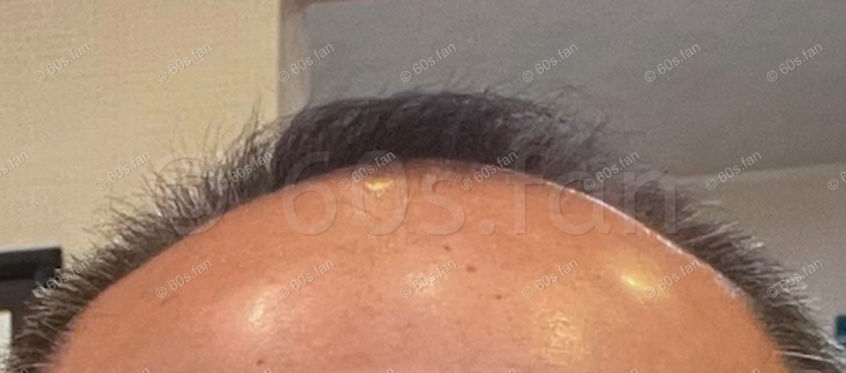 70代で発毛に挑戦、ビフォーアフター（ビフォー）