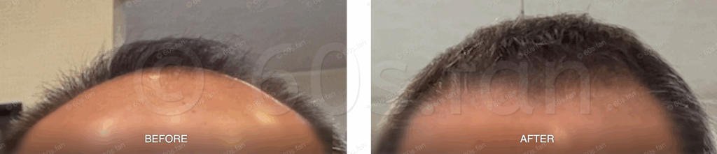 ミノキシジル・発毛履歴 2024/04/19〜2025/06/3