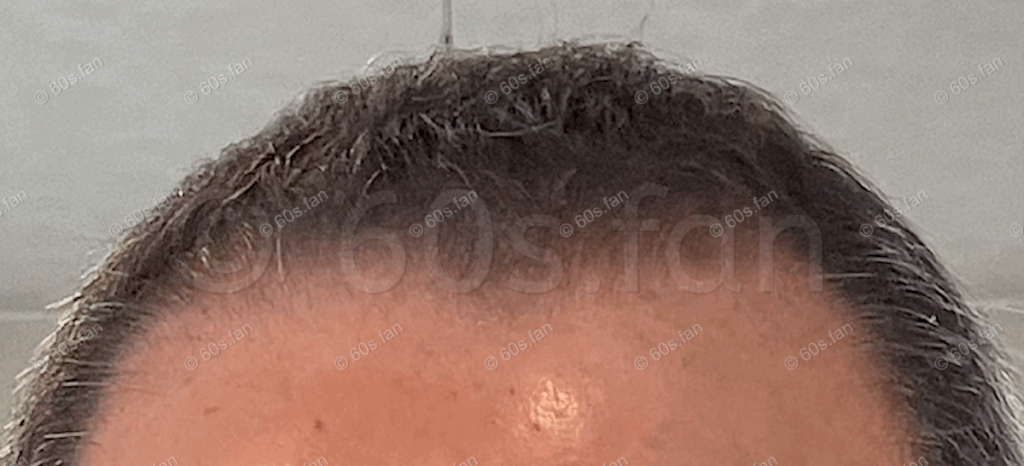 ミノキシジル外用薬14ヶ月使用による前頭部の発毛経過（2025年3月撮影）