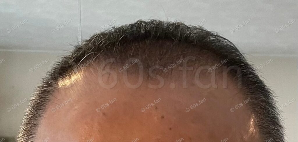 ミノキシジル外用薬4ヶ月使用による前頭部の発毛経過（2024年5月撮影）