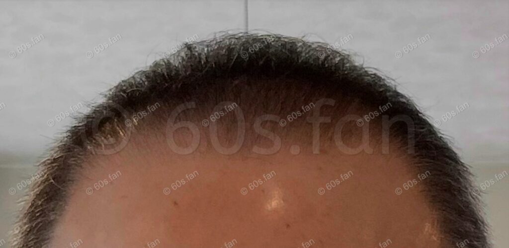 ミノキシジル外用薬7ヶ月使用による前頭部の発毛経過（2024年8月撮影）