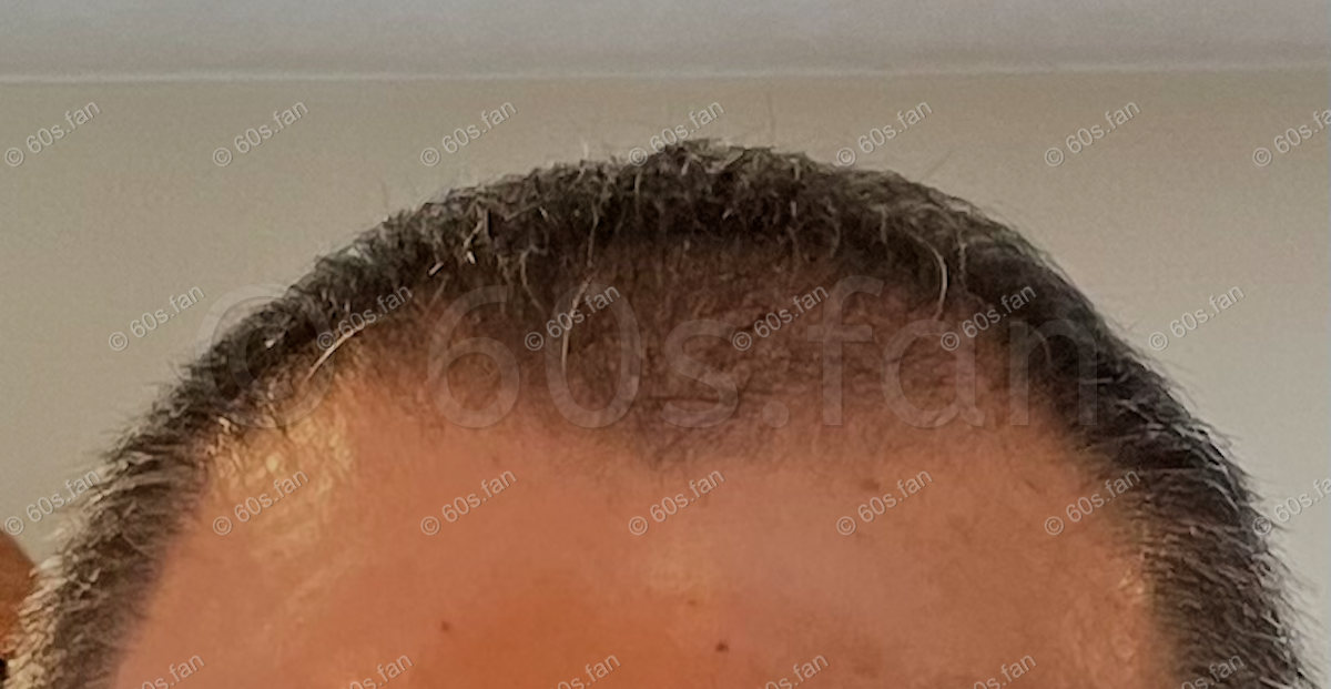 リアップ使用2ヶ月後の前頭部の発毛経過（2025年9月） 