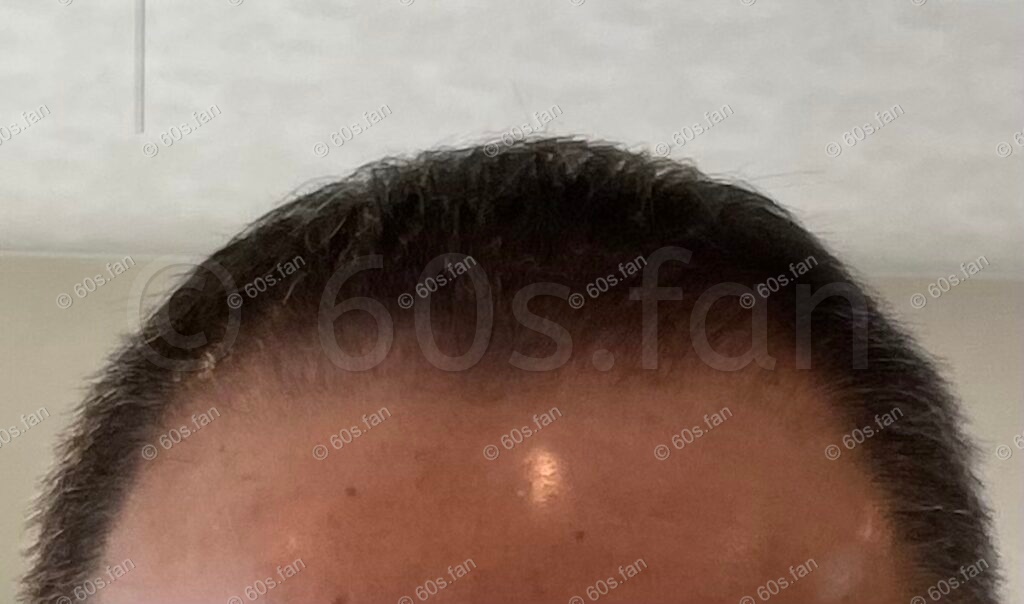 リアップ使用4ヶ月2週間後の前頭部（2025年11月）