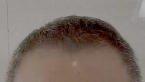 発毛 今月の頭部状態