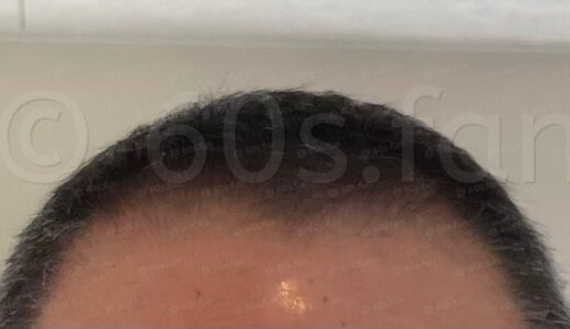 【美容師が断言】発毛期間中は「短髪」が最適である6つの理由—薬液の浸透率と視覚的な効果