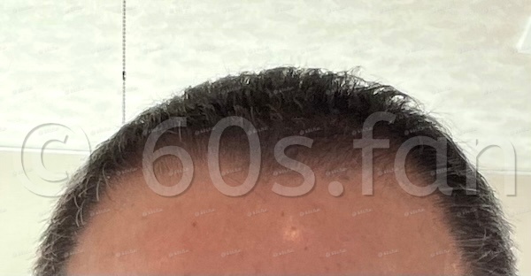 71歳発毛アフター2025のコピー