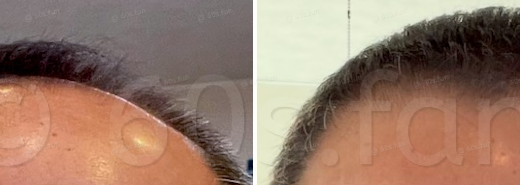 71歳の再起動｜漆黒の髪が物語る「肉体改造と発毛」の幸福な合流点