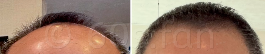 71歳発毛ビフォーアフターのコピー