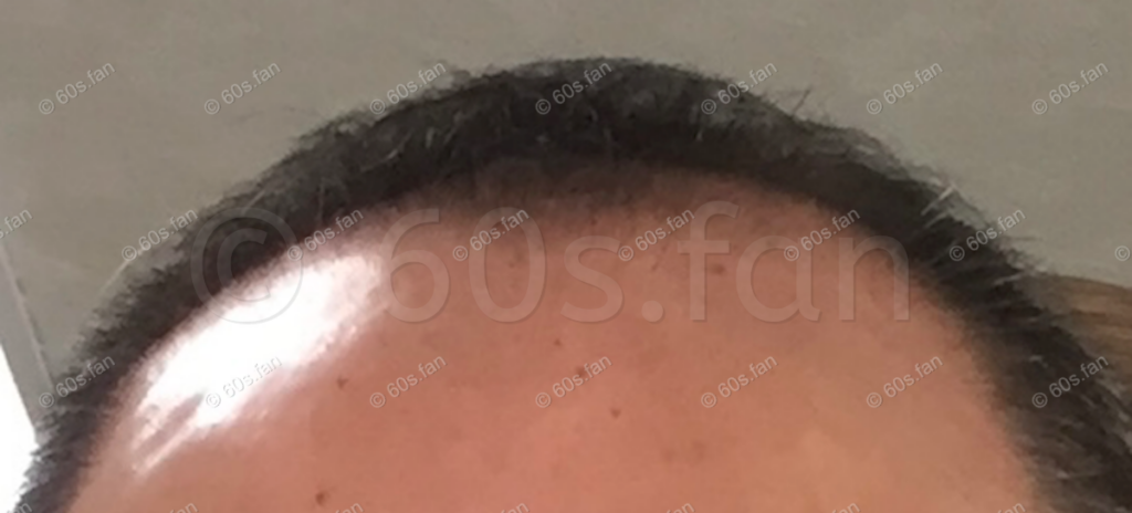 ミノキシジル外用薬4週間使用による前頭部の発毛経過（2024年1月撮影）