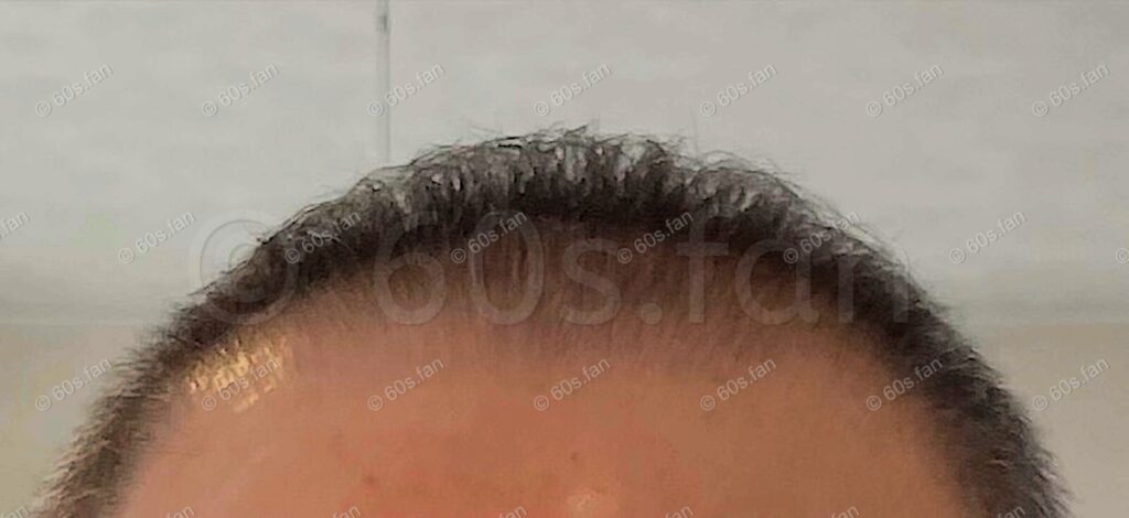 リアップ使用3週間後の前頭部の発毛経過（2025年8月）