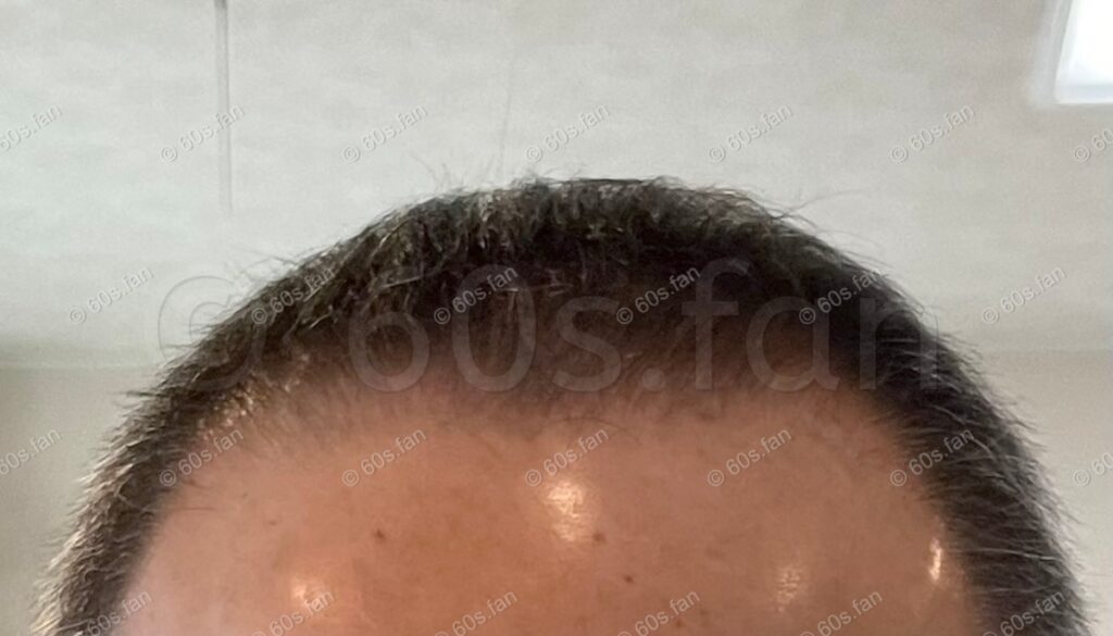 リアップ使用4ヶ月後の前頭部の発毛経過（2025年11月）