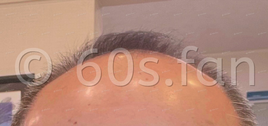 発毛に挑戦ビフォーのコピー