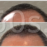 70代、髪はここまで戻せた｜1年9ヶ月の挑戦