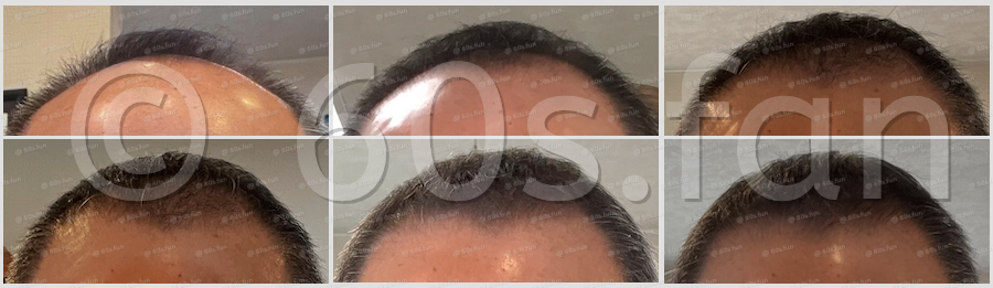 発毛履歴 60s.fan コピー禁止