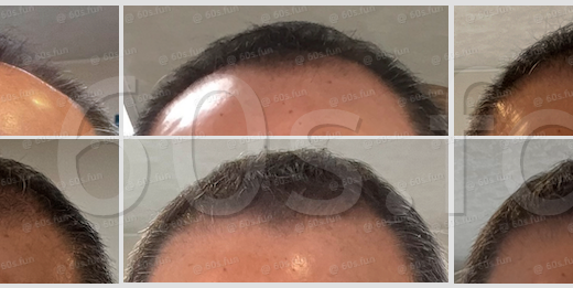 70代、髪はここまで戻せた｜1年9ヶ月の挑戦