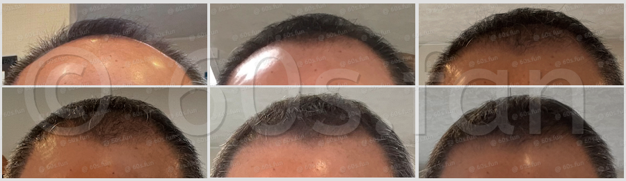 発毛履歴のコピー5